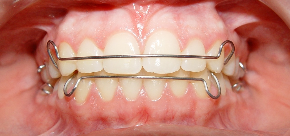 Jenis Behel Gigi- Global Estetik Dental Care