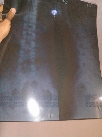 Rothgen Syaraf kejepit