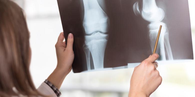 Apa itu osteosarcoma? Penyebab Gejala dan 3 Cara Pengobatan