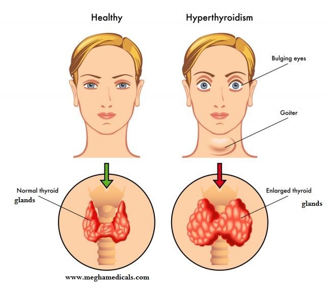 Kelenjar tiroid
