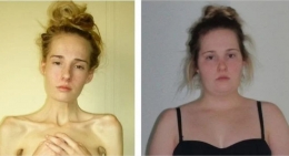 Perubahan Tubuh Drastis Gemma Walker Karea Bulimia | Sumber Situs Walipop