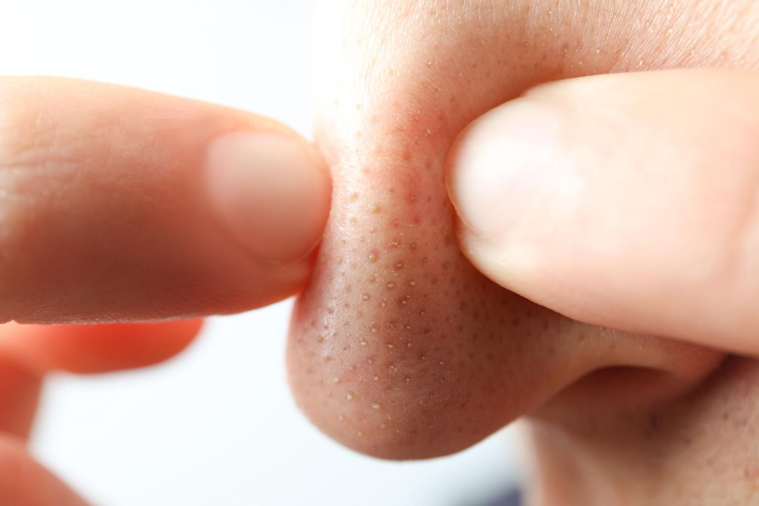 6 Penyebab Komedo Bisa Muncul di Hidung, Kepoin Yuk! - Kompasiana.com