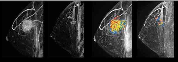 Foto Artikel : MRI BREAST PADA KANKER PAYUDARA - Kompasiana.com