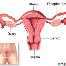 Mioma uteri adalah