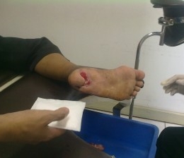 Gambar kaki luka kena kaca