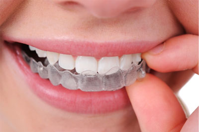 Hasil gambar untuk behel retainer