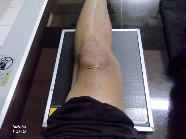 Gambar Kaki Luka Habis Jatuh Dari Motor - Kumpulan Gambar Menarik