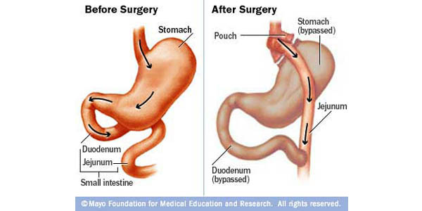 Trend Di Arab Ingin Kurus Secara Cepat Dengan Gastric Bypass Operasi Potong Lambung Halaman 1 Kompasiana Com