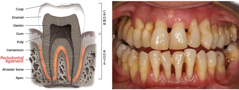 Sumber : http://www.3dk.cz/en/periodontology/chronic-periodontitis/