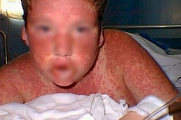 Sindrom Steven-Johnson sebagai salah satu contoh alergi obat tipe IV (sumber: http://vrachfree.ru/en/diseases-en/item/8109-syndrome-stevens-johnson-en)