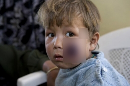 Salah seorang anak pengungsi Afghanistan yang terjangkit Leishmaniasis. Photo: WHO, Chistopher Black