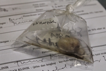 Pengalamanku Hidup Dengan Tumor Halaman All Kompasianacom