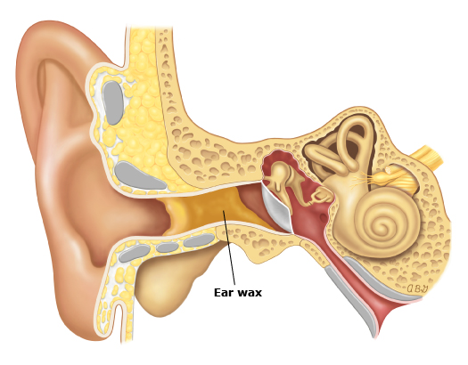 sumber: http://www.urgentcare.aw/main/patient-information-ear-wax-impaction-the-basics/
