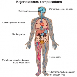 Komplikasi Diabetes (Gambar milik www.imhealth.com)