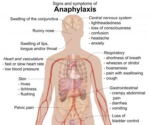 Anaphylaxis gejala yang paling berbahaya. Sumber: usercontent2.hubstatic.com