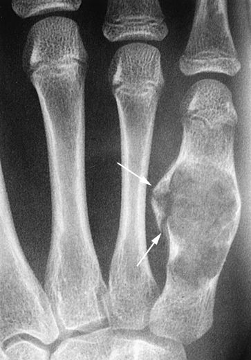Enchondroma pada tangan, tumor yang sudah membesar (image : http://cursoenarm.net/UPTODATE/contents/mobipreview.htm?10/55/11126)