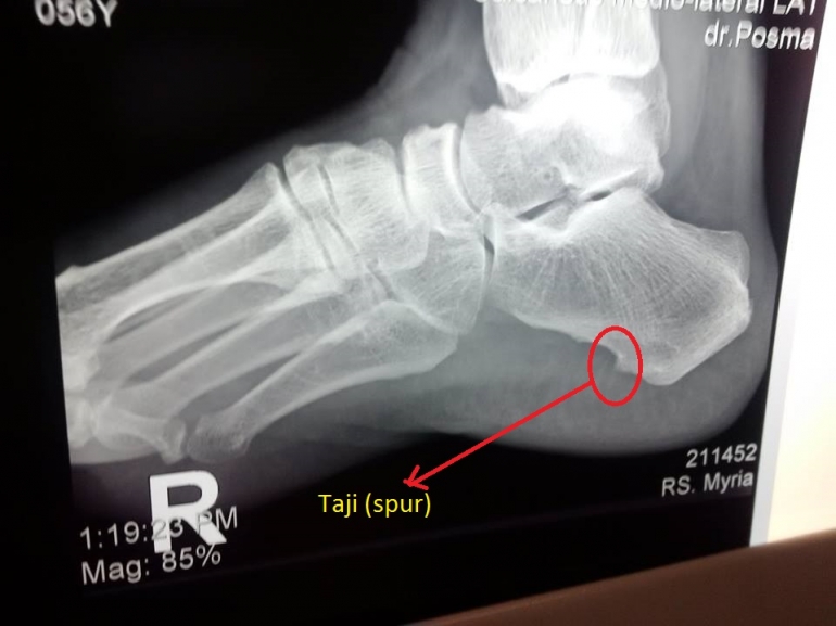 Peradangan tumit kronis yang membentuk 'taji' (dokumentasi pribadi)