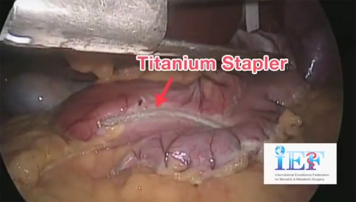 Titanium Stapler yang langsung merekatkan lambung ketika dipotong untuk diperkecil ukurannya. (Foto: bedahobesitas.com)