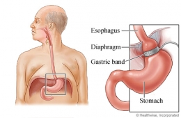 Operasi Bariatric Surgery tipe Gastric Band yang sudah semakin jarang dilakukan. (Sumber: webmd.com)