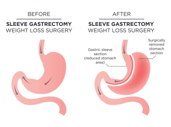 Operasi Bariatric Surgery tipe Sleeve Gastrectomy. (Sumber: vsscentre.com.au)