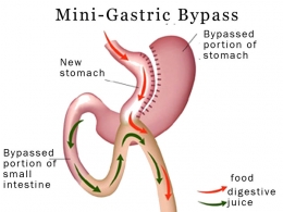 Operasi Bariatric Surgery tipe Mini Gastric Bypass. (Sumber: obesitysurgeonkerala.com)