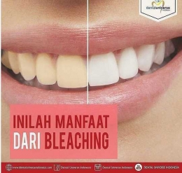 Bleaching dapat memutihkan gigi yang kuning. Foto : @dentaluniverse