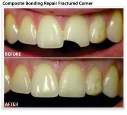 Gigi patah bisa di rapihkan kembali di dokter gigi. Foto : http://www.kompasiana.com/bambangtrihartomo