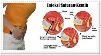 92+ Gambar Penyakit Infeksi Ginjal 92+ Gambar Penyakit Infeksi Ginjal