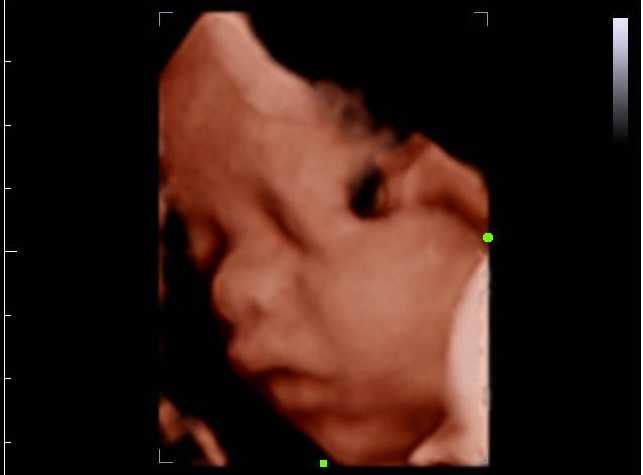 Usg 4 Dimensi Kehamilan Halaman 1 Kompasiana Com