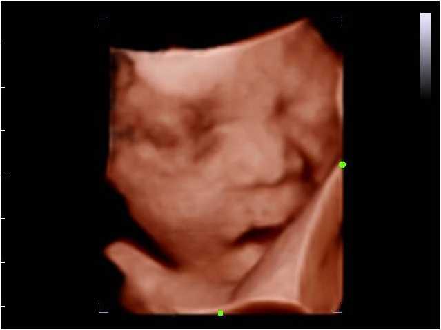 Gambar Usg 4 Dimensi Janin 8 Bulan Gambar Usg 4 Dimensi Janin 8 Bulan