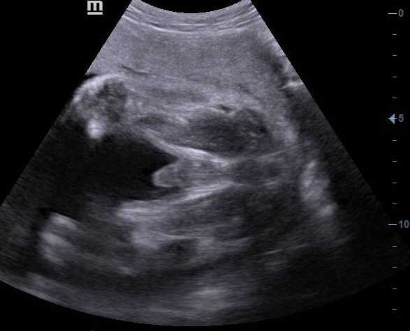 Terbaru 50+ Gambar Usg 2 Dimensi Bayi Laki Laki