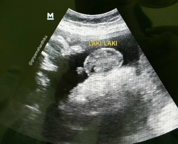 Usg 4 Dimensi Kehamilan Halaman All Kompasiana Com Usg 4 Dimensi Kehamilan Halaman All Kompasiana Com