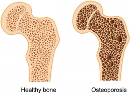 Osteoporosis  http://www.indimedical.com/osteoporosis-weakening-bones/