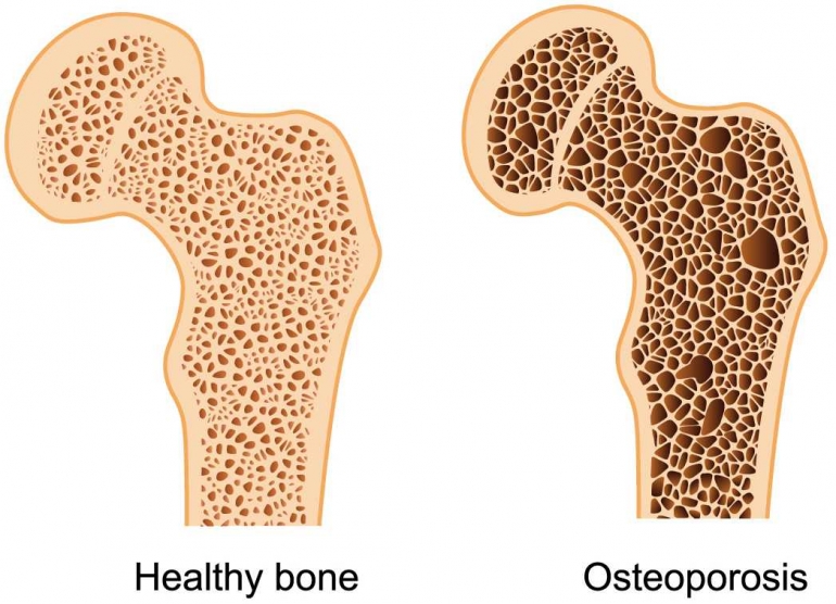 Osteoporosis http://www.indimedical.com/osteoporosis-weakening-bones/