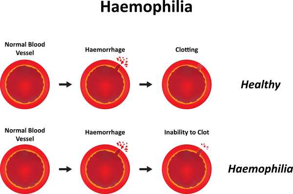 impaired-blood-clotting-in-hemophilia-5a1825c863b2487b9b708442.jpeg