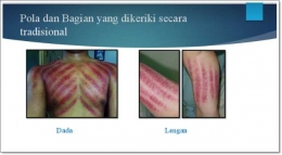 Bagian tubuh yang dkerok, bisa dada, punggung, tangan, dsb. Sumber : Materi Presentasi Prof.Dr.dr. Didik Gunawan Tamtomo