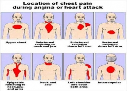 (Sumber gambar 4; Nyeri Ulu Hati (Epigastrium) Bisa Karena Serangan Jantung: http://www.balaherbs.com/images/heart-attack_clip_image008.jpg)