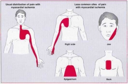 (Sumber gambar 2; Nyeri Ulu Hati (Epigastrium) Bisa Karena Serangan Jantung: https://pbs.twimg.com/media/B5txc-VIQAICa9D.png)