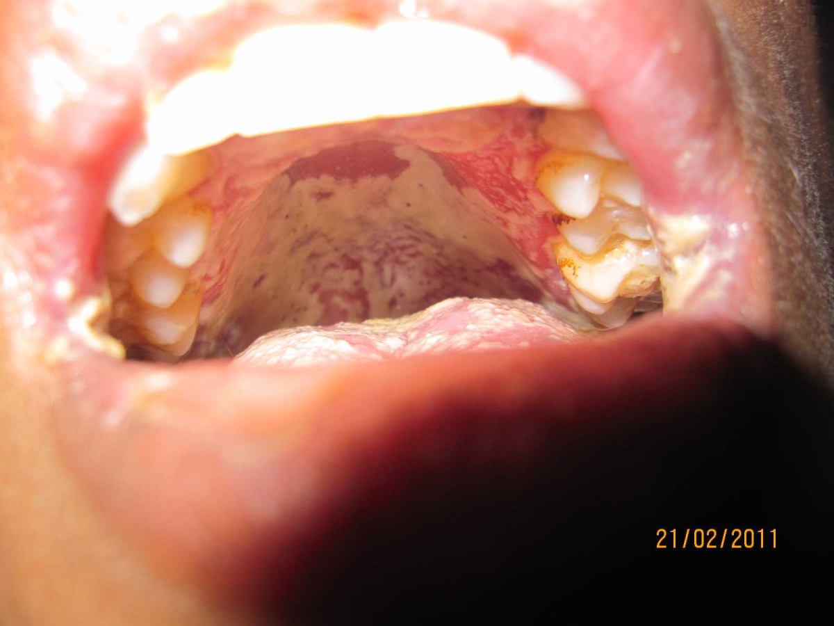 Foto Artikel : HIV/AIDS, Infeksi Jamur Rongga Mulut, dan Masalah Sosial ...