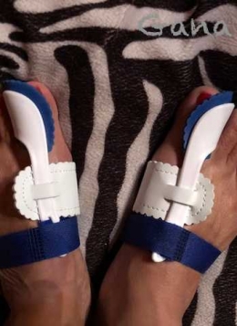 Bunion dikoreksi pakai foot orthotics, jempol dipasung (dok.Gana)