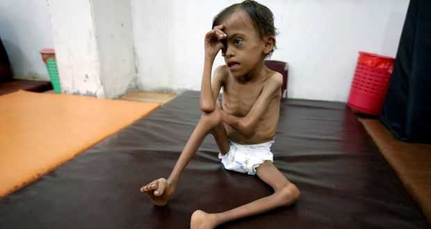 Marwan Akhmad Mayoub usia 10 tahun korban tragedi kemanusiaan Yaman. Photo: Abuldjadbar Zeyad, Reuters
