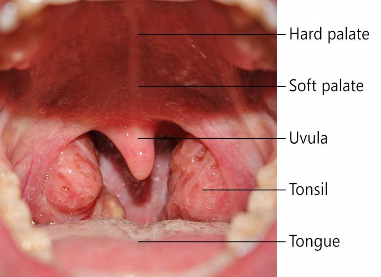 (Foto 1: Tenggorokan dan Tonsil (Amandel):; Sumber foto: http://www.healthhype.com/wp-content/uploads/normal_healthy_throat_tonsils.jpg)