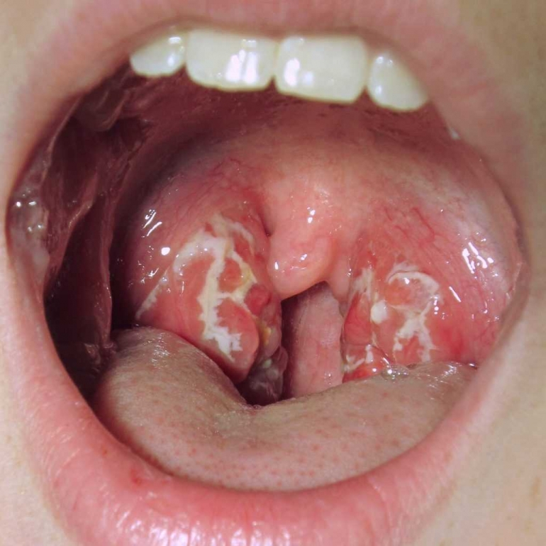 (Foto 2: Strep Throat, dengan bercak-bercak putih pada amandel (tonsil); Sumber foto:https://www.regaltribune.com/wp-content/uploads/2017/03/strep-throat-infection-1024x1024.jpg)