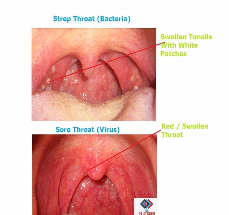 (Foto 3: Perbedaan antara Strep Throat (infeksi bakteri) dan Sore Throat (infeksi virus); Sumber foto: https://thelifesquare.com/wp-content/uploads/2016/01/What-Is-Strep-Throat-And-How-Does-It-Differ-From-Common-Sore-Throat.jpg?x30295)