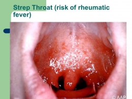 (Foto 4: Strep Throat, kemerahan pada dinding langit-langit mulut dan tenggorokan; Sumber foto: http://images.slideplayer.com/22/6427965/slides/slide_62.jpg)