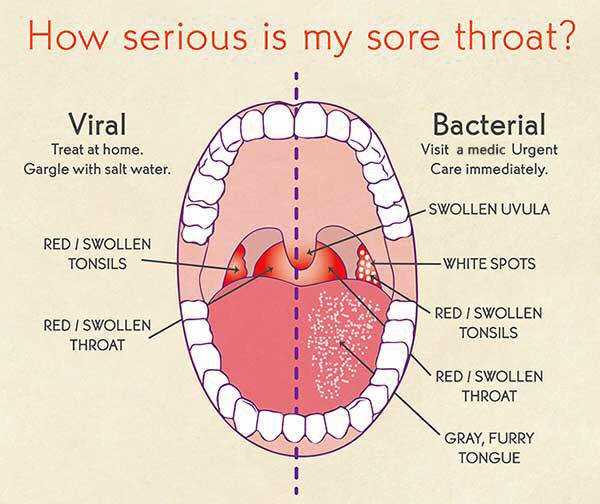 (Gambar 1: Perbedaan antara Strep Throat (infeksi bakteri) dan Sore Throat (infeksi virus); Sumber gambar: https://i.pinimg.com/564x/1e/a5/f5/1ea5f54f51c386c0cdfd338f5065c0af--strep-throat-massage.jpg)