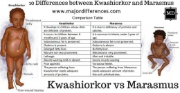 sumber :http://www.majordifferences.com/2017/11/10-differences-between-kwashiorkor-and-marasmus-Kwashiorkor-vs-marasmus-in-table-form.html#.WmdwAHZl_IU