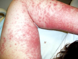 (Foto 1: Tanda alergi obat pada kulit; sumber:https://www.omicsgroup.org/articles-admin/disease-images/drug-allergy-29436.jpg) 