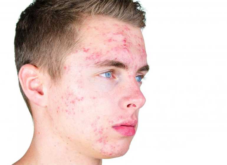 source: http://images.wisegeek.com/boy-with-facial-acne.jpg