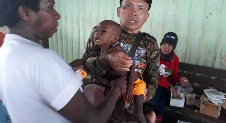 Anak korban gizi buruk di Asmat begitu kurus dan kesehatan buruk. Foto: reportase.com